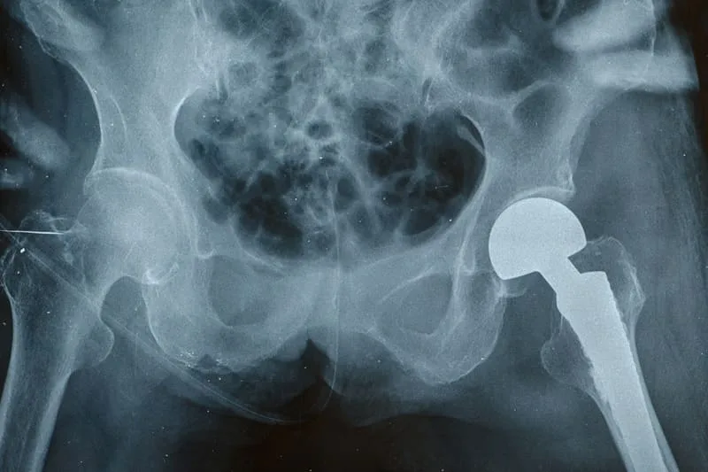 Cirugía especializada en reemplazos articulares (prótesis de rodilla y cadera)